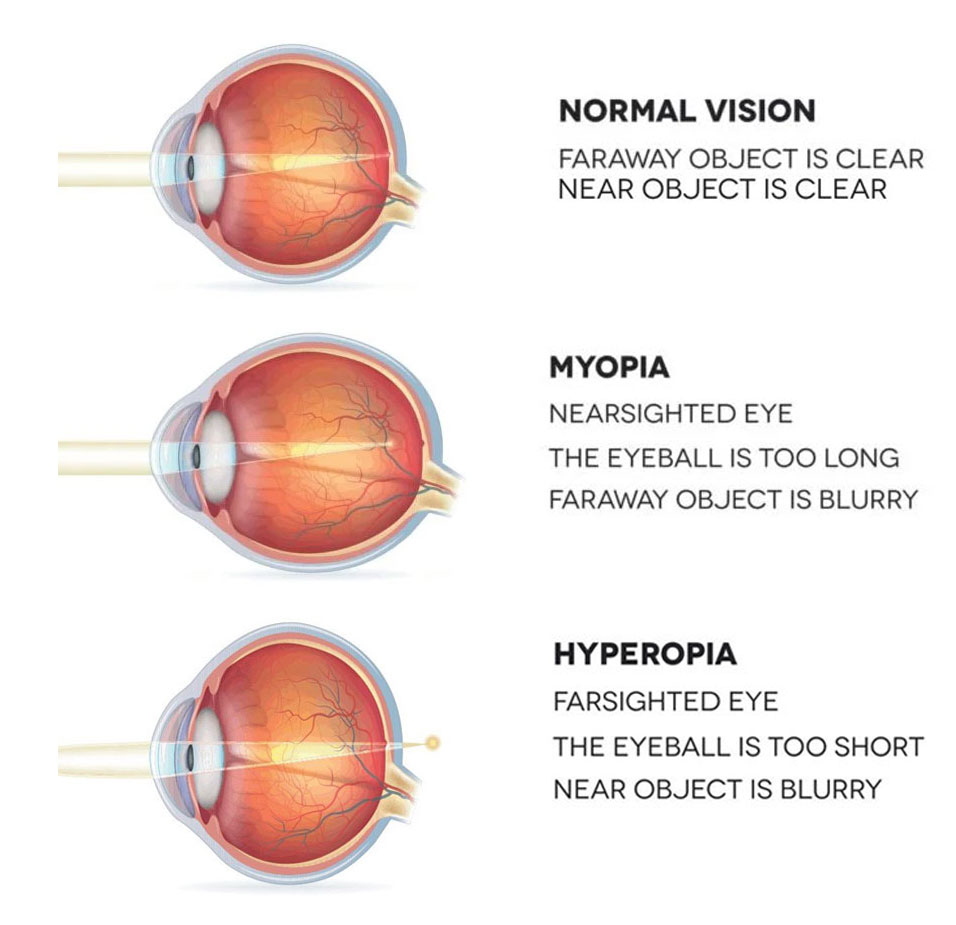 Is Nearsightedness Due to the Eyeball Being Too Long?